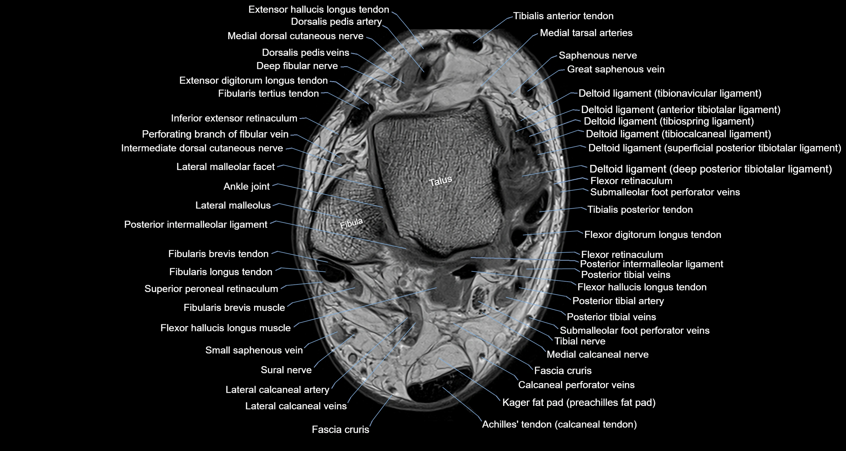 Ankle axial anatomy 3T MRI images -img-10001-00016.webp